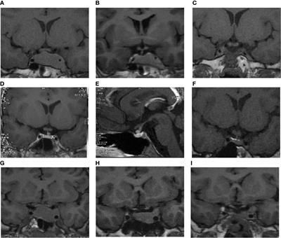 Clinical and Therapeutic Characteristics of Pituitary TSH-Secreting Adenoma in Adolescent-Onset Patients: Six Case Studies and Literature Review